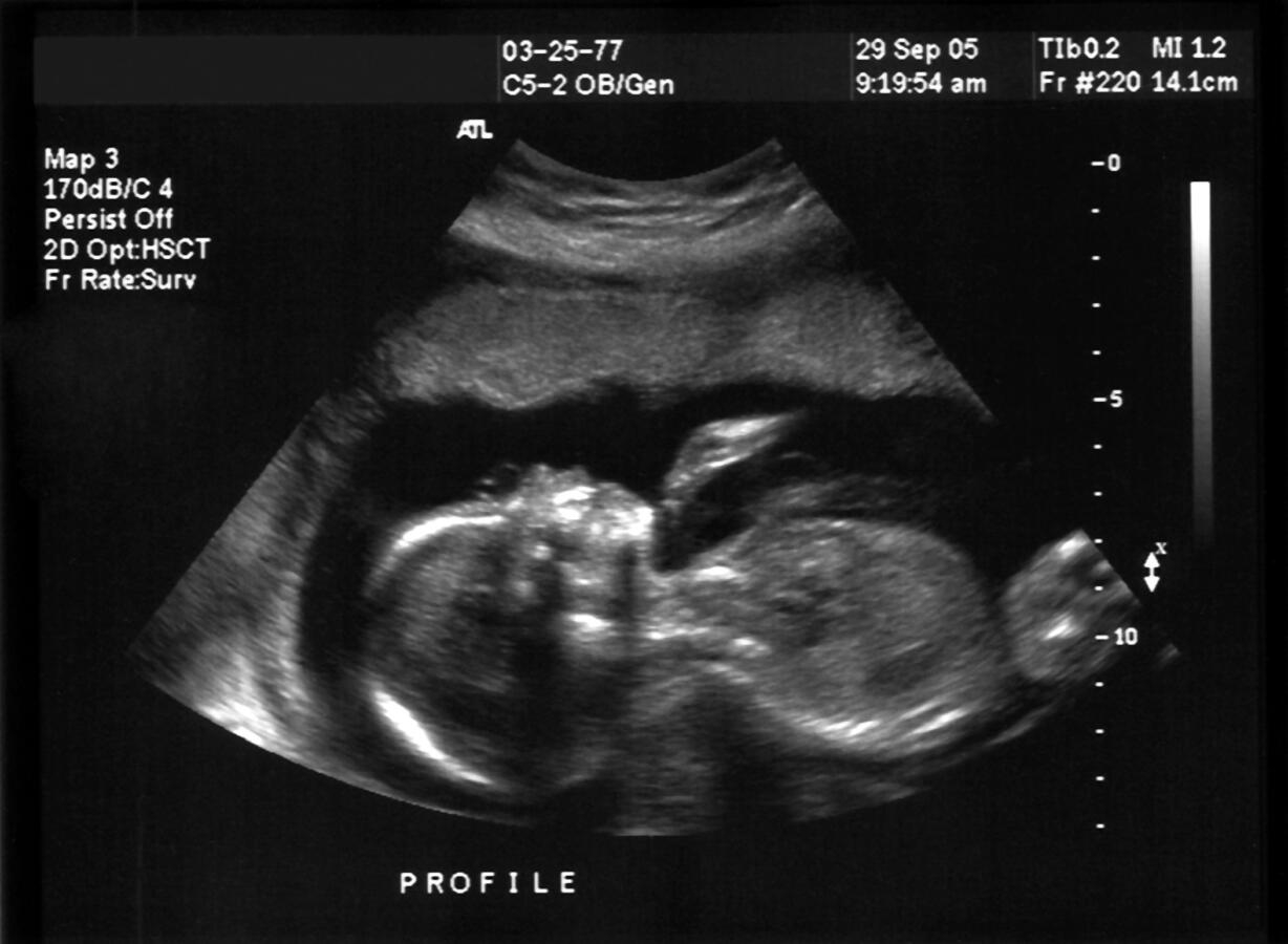 black and white ultrasound image of a fetus
