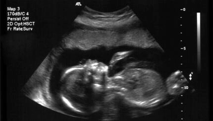 black and white ultrasound image of a fetus