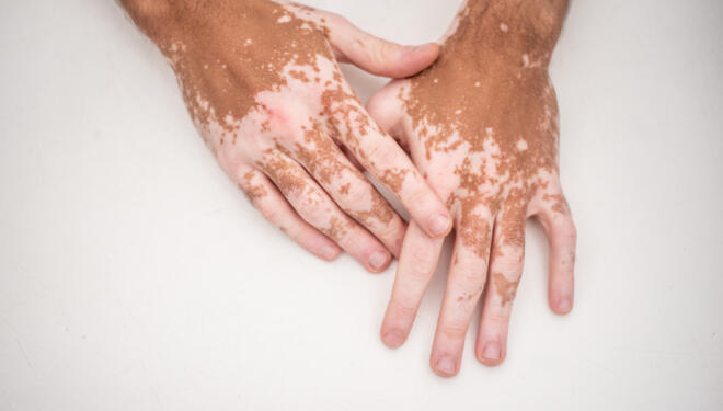 photograph of man's hands with vitiligo